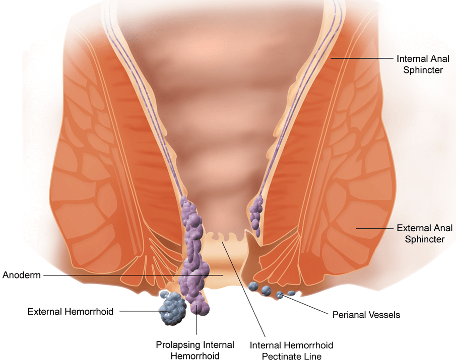 The development of hemorrhoids is accompanied by pain, itching and loss of lymph nodes