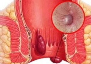 What do hemorrhoids look like